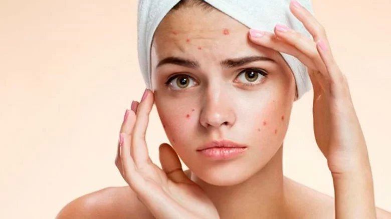 Receitas caseiras para tratar acne são eficazes?