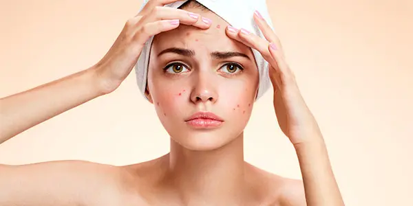 Como Combater a Acne de Forma Natural: Dicas e Tratamentos Caseiros