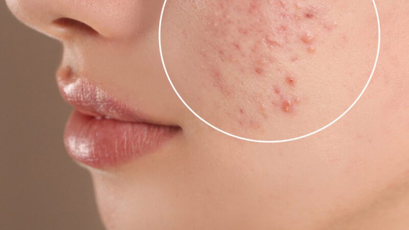 Como Combater Acne: Dicas Eficazes para uma Pele Livre de Imperfeições