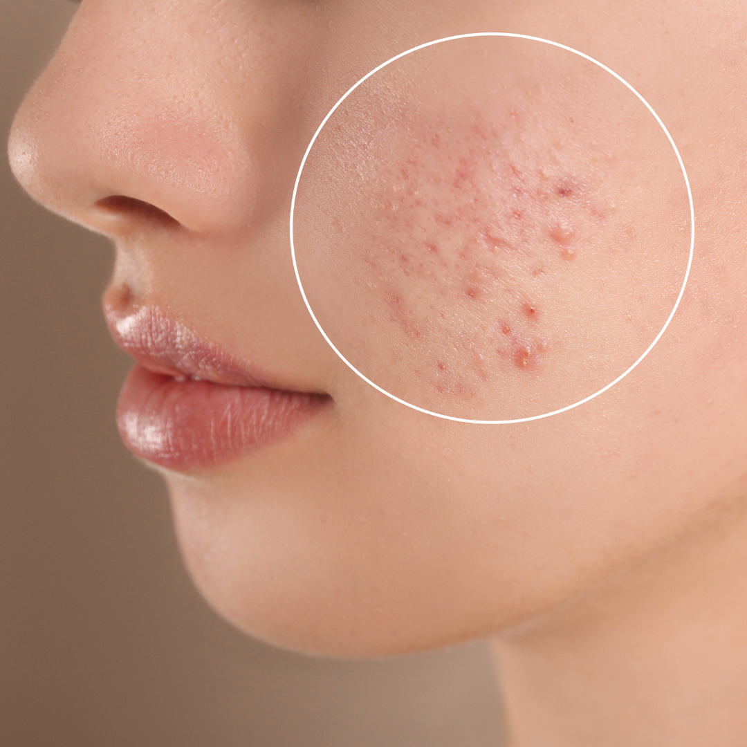 Como Combater Acne: Dicas Eficazes para uma Pele Livre de Imperfeições