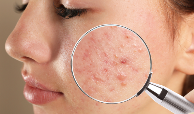 Como Combater a Acne de Forma Natural: 15 Estratégias Que Realmente Ajudam a Melhorar a Pele