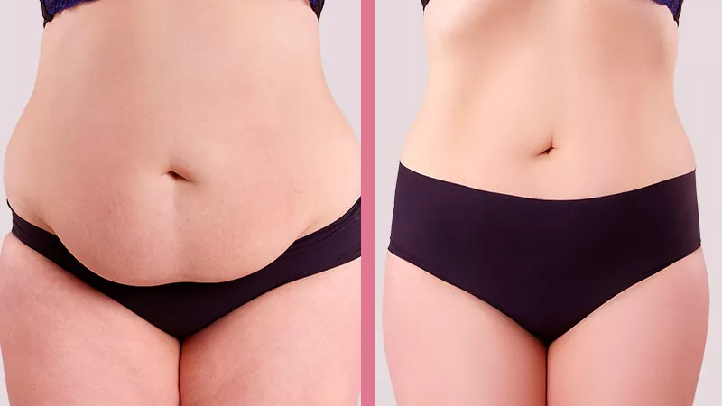 Lipo com Retração da Pele: A Tecnologia Que Está Mudando os Resultados da Lipoaspiração em 2026
